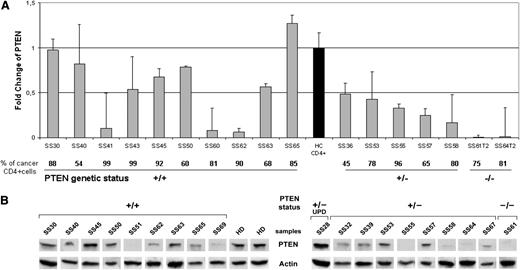 Figure 2. PTEN levels measured in SS patients. (A) qRT-PCR analysis of PTEN performed in 17 SS patients. The PTEN mRNA level was calculated for each SS patient relatively to a reference pool consisting of 5 healthy controls (black bar). The bottom portion indicates the percentage of clonal TCR vβ+ cells within the CD4+ fraction and the PTEN status represented as wild type (+/+), heterozygous deletion (+/−), and homozygous deletion (−/−). Samples were measured in 2 independent experiments performed in triplicate. (B) Western blotting analysis of PTEN in the purified CD4+ cells of 19 SS individuals grouped by PTEN +/+, +/−, and −/−, and UPD genomic status. Two representative HDs of the 5 analyzed are shown in the figure. Because of the timing of patient recruitment, the gels were run at separate times and the lanes were composed for the figure.