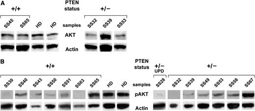 Figure 4. Basal and phospho-AKT levels measured in SS patients. (A) Western blotting analysis for AKT performed in sorted CD4+ lymphocytes from 5 SS patients. Two representative HDs of 5 patients analyzed are shown. (B) Western blotting analysis for phospho-AKT of sorted CD4+ lymphocytes from 14 SS patients. Two representative HDs of 5 patients analyzed are shown. Because of the timing of patient recruitment, the gels were run at separate times and the lanes were composed for the figure.