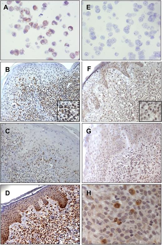 Figure 5. Immunohistochemistry of PTEN and pAKT performed in SS and MF skin biopsies. (A) Hut78 as a positive control for PTEN (original magnification ×40/0.7 numerical aperture); (B-C) PTEN immunoreactivity in SS skin (B, original magnification ×20/0.6 numerical aperture; C, original magnification ×10/0.3 numerical aperture); (D) PTEN immunoreactivity in MF (original magnification ×20/0.6 numerical aperture); (E) HH as a negative control for PTEN (original magnification ×40/0.7 numerical aperture); (F-G) pAKT immunostaining associated with the cytoplasm of keratinocytes and scattered malignant lymphocytes (original magnification ×20/0.6 numerical aperture); and (H) strong pAKT positivity associated with the cytoplasm of SS cells and particularly with actively dividing mitotic cells (original magnification ×40/0.7 numerical aperture). Digital images were acquired with an AxioCam MRc5 camera (Zeiss) and an Axioskop2 microscope (Zeiss).