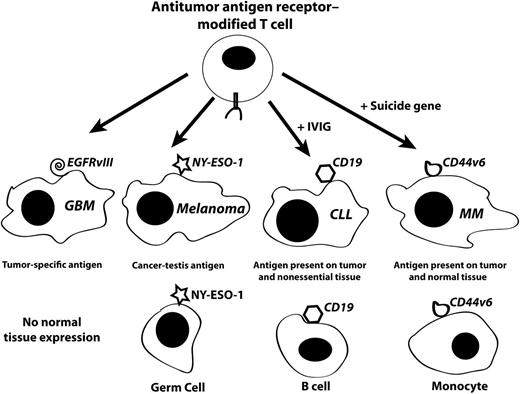 Target antigen types for adoptive cell therapy. T cells can be genetically modified with tumor-targeting receptors (either T-cell receptors or CARs) and administered to patients in adoptive cell therapy trials. The types of tumors and tumor antigens targeted by these modified T cells can have no or significant off-tumor/on-target toxicity dependent on antigen expression. For tumor-specific antigens such as EGFRvIII in glioblastoma (GBM), there will likely be no toxicity due to the lack on antigen expression in normal tissues. Some (but not all) CT antigens have gene expression patterns limited to cancer and the non–MHC-bearing germ cells in the testis (eg, NY-ESO-1 in melanoma). It may be clinically acceptable to target tumor antigens that are expressed in malignancies and nonessential tissues such as the example of CD19, which is expressed in chronic lymphocytic leukemia (CLL) but also in normal B cells. B-cell depletion can be managed by IV immunoglobulin (IVIG) administration. The majority of tumor antigens follow the pattern investigated by Casucci et al, where the CD44v6 antigen is expressed in the tumor (eg, MM) as well as in normal tissues. As a potential method to manage expected monocytopenia, the investigators suggest that a suicide gene could be used to eliminate T cells after the antitumor response is complete.