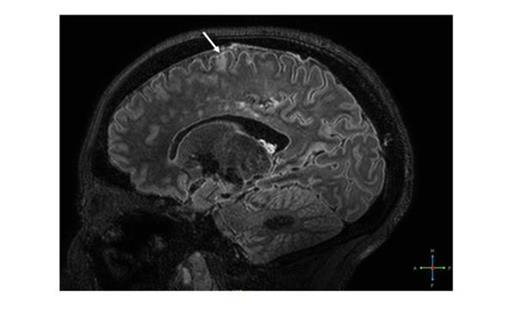 Figure 2. Cortical micro-infarct (arrow) and associated white matter infarcts in patient B, 7T MP-FLAIR image.