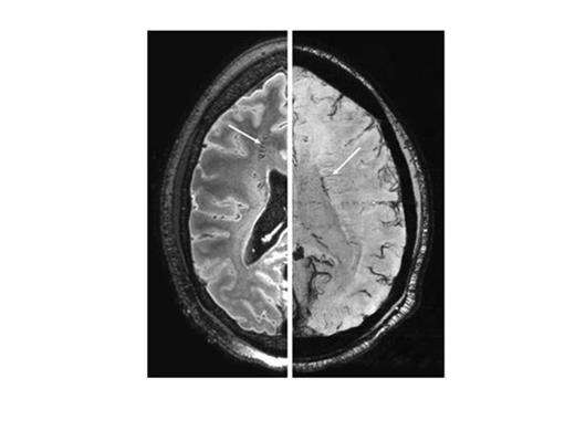 Figure 3. 7T MP-FLAIR image (left) with hypo-intense structures (arrow) in patient C, and 7T dual-echo T2*-weighted scan (right) with prominent transmedullary veins (arrow).