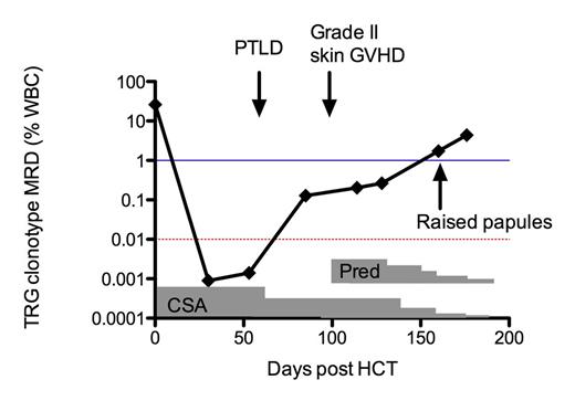 Figure 1. MRD levels over time in a T-PLL patient. Red dotted line indicates detection level by 4-color flow cytometry (0.01%), blue line indicates detection level by pathology (1%).