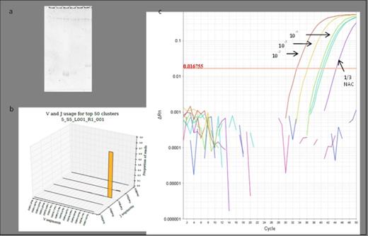 Figure 1. (a) Polyacrylamide electrophoresis could not recognise a target to use in current MRD methodologies (well 1 containing the products from a PCR reaction that would amplify VH1 and VH7, and wells 2-6 amplifying VH2-6, respectively), while the NGS pipeline could identify a VH7 rearrangement (b). (c) ASOs were designed to amplify the NGS-identified VH7-81*01 DH3-9*01 JH4*02 rearrangement and optimised to correctly identify 10-2, 10-3, 10-4 dilutions with a single NAC (non-amplification control; monocytes from 20 normal individuals) replicate amplified, therefore meeting current guidelines for a MRD target.
