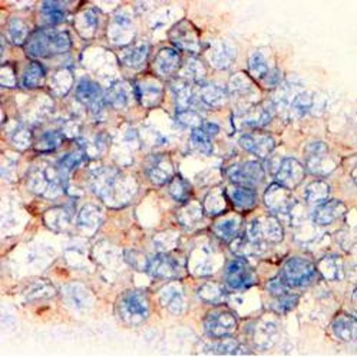 Fig.1. PD-L1 expression in MDS CD34+ cells by IHC.