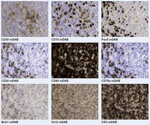 Fig.1. Representative virtual brightfield images of the nine biomarkers from the same field of view in a Hodgkin Lymphoma sample.
