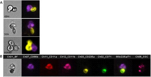Figure. Representative images of circulating Neut-RBC agg from CON and SCA individuals. / (A) Brightfield (BF) and respective fluorescent images: purple color – CD66b (Neut); yellow color – CD235a (RBC). / (B) BF and fluorescence staining imaging of adhesion molecules analyzed on Neut-RBC agg from an SCA individual; CD66b, CD11a, CD11b, CD235a, CD71, SSC; side scatter.