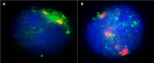 Figure 1. Figure 1 Jurkat cells were transfected with the HIV-1-LTR-CAT plasmid, and were then stained for the Ets-2 protein (green spots) and HIV-LTR (red spots), and counterstained with DAPI (blue). A. Jurkat cells in CM condition. Ets-2 and HIV-LTR co-localize inside the nucleus (yellow spots). B. Jurkat cells activated with P/I for 12h. Ets-2 no more co-localizes with the HIV-1-LTR sequence.