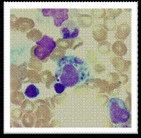 Figure 1. Bone marrow aspirate of this patient showing evidence of haemophagocytosis (H & E). A and B show large macrophages undergoing phagocytosis of different cellular elements of the bone marrow.
