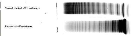 Figure 1. Normal von Willebrand protein multimers (top) by gel electrophersis, and patient's multimers by gel electrophoresis (bottom), consistent with Type II vWD.