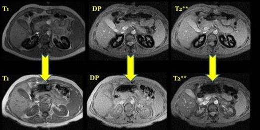 Figure I. MRI before and after eculizumab treatment, case number 2. ( T1, DP and T2**) After a year of treatment we observed a depletion of iron deposits in the renal cortex.