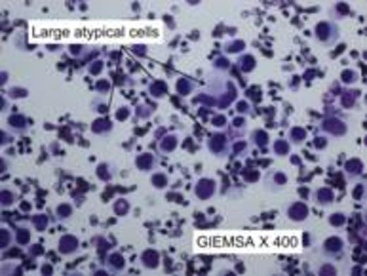 Figure 1. A and B, show presence of large atypical lymphocytes with scanty cytoplasm and some with kidney shape nuclei. C, confirms the cells are strongly positive for CD30