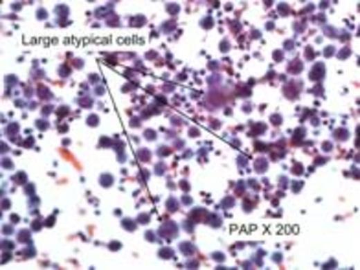 Figure 1. A and B, show presence of large atypical lymphocytes with scanty cytoplasm and some with kidney shape nuclei. C, confirms the cells are strongly positive for CD30