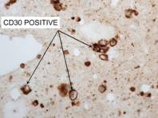 Figure 1. A and B, show presence of large atypical lymphocytes with scanty cytoplasm and some with kidney shape nuclei. C, confirms the cells are strongly positive for CD30