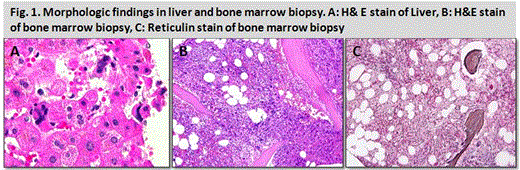 Figure 1. Morphologic findings in liver and bone marrow biopsy. A: H& E stain of Liver, B: H&E stain of bone marrow biopsy, C: Reticulin stain of bone marrow biopsy