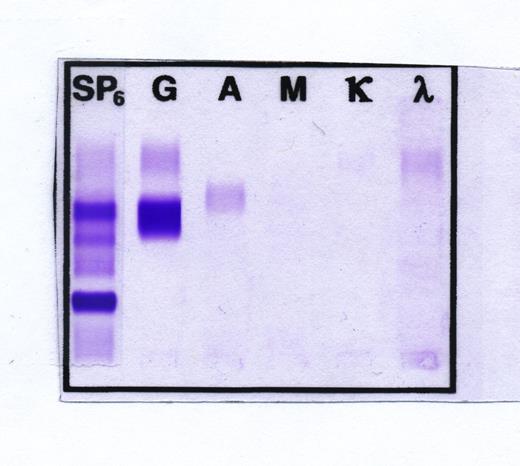 Figure 1. IFE demonstrating monoclonal IgG without corresponding light chain