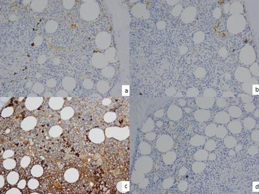 Figure 3a. Few PCs + kappa light chain by IHC. 3b. Few PCs + for lambda light chain by IHC 3c. Majority of PCs show + IgG by IHC. 3d. PCs - IgM by IHC.