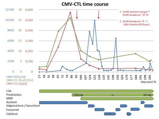 Figure 1. Time course of CMV-CTLs after transplantation for AML. High levels of CMV-CTLs appear to control CMV-infection. Following steroid exposure CMV-CTLs decrease and the patient developed a CMV disease with CMV enteritis requiring different antiviral treatment.