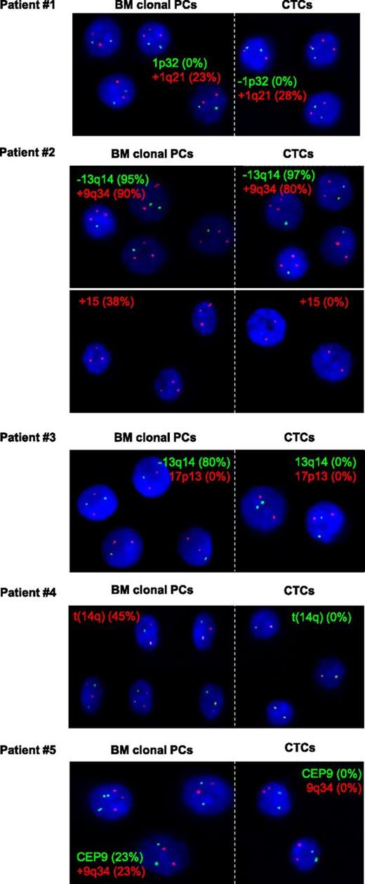 Figure 3. Representative FISH microscopic photographs of FACS-purified PC nuclei from BM clonal PCs and their paired CTCs from 5 MM patients. For each patient, selected probes with the corresponding percentage of altered PC nuclei are shown for BM clonal PCs (left panels) and their paired CTCs (right panels).
