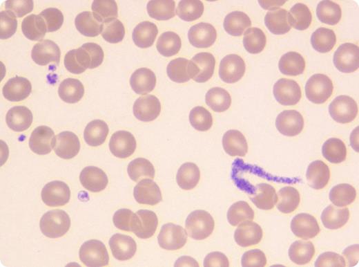 An 82-year-old woman was admitted to our institution with profound thrombocytopenia (1 × 109/L) without bleeding symptoms. The diagnosis of immune thrombocytopenic purpura had been made 18 months earlier, and the patient had presented recurrent thrombocytopenic relapses since then. A treatment with intravenous gamma globulin was initiated for the current episode. Two days later, her platelet count had increased to 60 × 109/L. On this occasion, her blood smear showed the unusual image of a proplatelet, appearing as a thin, elongated, and seamless cytoplasmic strand with the same tinctorial affinity as platelets. No platelet clumps were found on the smear. / The mechanisms of platelet production are still incompletely understood. Either megakaryocytes extend long cytoplasmic structures called proplatelets through the vascular wall of bone marrow sinusoids, or megakaryocytes are wholly released in the circulation and develop proplatelets under the circulatory shear stress. Both models suggest that proplatelets are present in the bloodstream where they further fragment into platelets. However, if proplatelets are usual observations in megakaryocyte cultures, they are very rarely seen in the peripheral blood. This image, observed in a situation where platelet production is stimulated, supports the relevance of these 2 models of in vivo platelet production in human physiology.