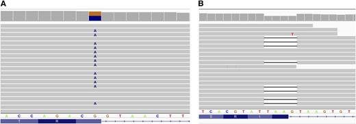 Figure 1. WES in NA. Integrated genome browser view of reads from select regions of the VPS13A gene generated by exome sequencing. (A) Exon 69. Approximately half of full-length reads have A instead of G, leading to a missense mutation, thereby disrupting the exon 69 donor splice junction. (B) Exon 58. Approximately half of full-length reads lack 4 nucleotides, TAAG, corresponding to the end of exon 58 and the first nucleotide of intron 58.