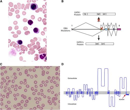 Figure 2. Identifying hematologic diseases using WES. (A) Blood smear from a patient with HX demonstrates rare stomatocytes, target cells, and dessicytes (dense, erythrocytes with hemoglobin appearing to be puddled at the periphery). (B) WES identified mutations in PIEZO1, encoded by the FAM38A gene, as the HX disease locus. The location of this patient’s mutation is denoted by the arrow on a model of PIEZO1 created using hmmtop2 software. Adapted from Zarychanski et al35 with permission. (C) Blood marrow aspirate smear from a patient with DBA demonstrates only rare erythroblasts. (D) WES identified mutations in the GATA1 gene, leading to altered splicing and production of a short protein form of GATA1 protein (GATA1s) that lacks the NH2-terminal TD present in full-length GATA1. CF, COOH-terminal zinc finger; NF, NH2-terminal zinc finger; TD, transactivation domain. Adapted from Sankaran et al28 with permission.