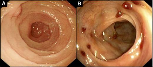 Figure 1. Endoscopic findings in indolent T-LPD of the GI tract. (A) Irregular appearance of duodenal mucosa (case 9). (B) Multiple small polyps with mucosal erythema in the colon (case 2).