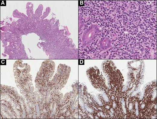 Figure 3. Indolent T-LPD of the duodenum (case 9). (A) A dense infiltrate involving the lamina propria, muscularis mucosae, and submucosa. (B) The infiltrate is composed of small lymphoid cells with slightly irregular nuclei and occasional admixed eosinophils. Immunohistochemical stains for (C) CD4 and (D) CD8 show the lymphoid cells to be predominantly CD8-positive and focally involve the villous epithelium. (A: H&E, original magnification ×40; B: H&E, original magnification ×400; C-D: immunohistochemical stain, original magnification ×100.)