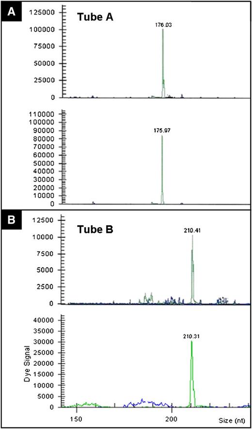 Figure 4. TCR-γ chain gene rearrangement (case 10). Studies were performed using BIOMED2 primers. TCR-γ chain assessment by (A) tube A and (B) tube B in oral (upper panels on A-B) and intestinal (lower panels on A-B) lesions that show identical gene rearrangement patterns.