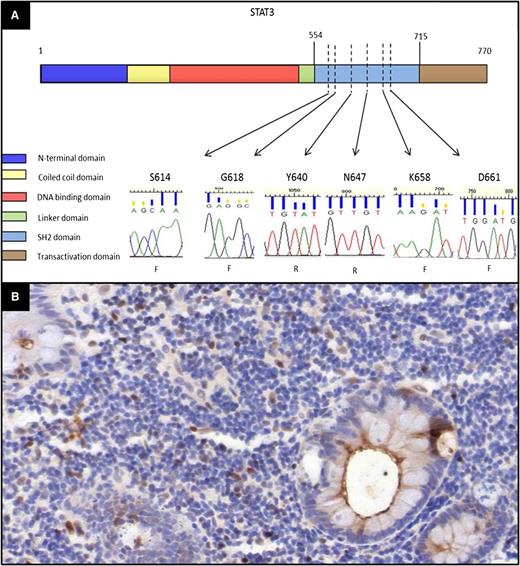Figure 5. Evaluation of the mutation status of STAT3 and immunohistochemistry for pY-STAT3 in indolent T-LPD. (A) Sanger sequence chromatograms for STAT3 mutation hot spots showing only wild-type sequences. The amino acid residues corresponding to the sequence evaluated are shown over each chromatogram (F, forward primer sequencing; R, reverse primer sequencing). The domains of the STAT3 protein were shown based on the National Center for Biotechnology Information Reference Sequence NP_644805. The locations of the STAT3 hot spots were indicated based on the STAT3 SH2 domain mutations identified in T-cell and NK-LGLL cases in 2 recent studies.16,17 (B) Immunohistochemical stain for phospho-STAT3 showing only a few scattered positive cells as well as fewer strongly positive cells. (Immunohistochemical stain, original magnification ×200.)