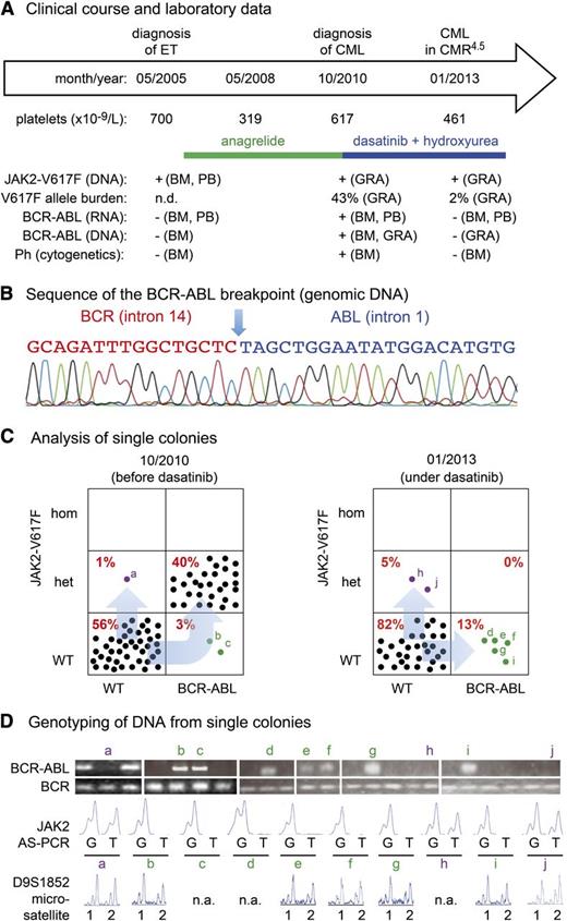 Figure 1. Patient characteristics, BCR-ABL breakpoint sequence, and genotyping of single colonies. (A) Clinical diagnoses, treatment history, and diagnostic workup of a 56-year-old female patient with coexisting JAK2-V617F mutation and BCR-ABL rearrangement. BM, bone marrow; CMR4.5, complete molecular remission with a log4 to log5 reduction of BCR-ABL transcripts; GRA, granulocytes; n.d., not determined; Ph, Philadelphia chromosome. (B) Sequencing chromatogram of a 157-bp amplicon derived from granulocyte DNA revealed the breakpoint sequence in the intron 14 of BCR and intron 1 of ABL. The same sequences were obtained in colonies positive for BCR-ABL. (C) Analysis of single colonies for mutation in JAK2-V617F and BCR-ABL rearrangement in the genomic DNA before and after tyrosine kinase (dasatinib) therapy. Mononuclear cells from peripheral blood were grown in methylcellulose in the presence of erythropoietin. Single burst-forming units erythroid (BFU-E) and non–BFU-Es (ie, CFU-G and CFU-GM) were picked and analyzed individually for the presence of JAK2-V617F mutation by allele-specific PCR. Each colony is represented by a dot that is placed into 1 of 6 quadrangles representing the 6 possible genotypes: wild-type (WT), heterozygous (het) and homozygous (hom) for JAK2-V617F on the vertical axis, and for BCR-ABL on the horizontal axis. Percentages are shown in red for each possible genotype. (D) Genotyping of DNA from single colonies. Ethidium-bromide–stained PCR fragments for the BCR-ABL breakpoint and for BCR (loading control) were separated by agarose gel electrophoresis (top panel). The chromatograms of the allele-specific PCR assay (AS-PCR) show the presence or absence of the wild-type “G” or mutant sequence “T” in codon 617 of JAK2. The results of individual colonies marked with small letters in panel C are shown. Results of microsatellite analysis for a marker on chromosome 9p are shown below. Note that all colonies tested retained both alleles (1 and 2), excluding uniparental disomy as the reason for the loss of BCR-ABL/JAK2-V617F double-mutant colonies. n.a., not available.