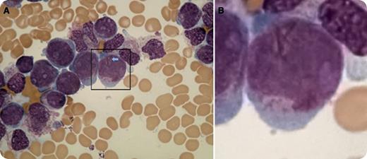 A 34-year-old man presented with gum bleeding. His complete blood count revealed hemoglobin, 10 g/dL; red blood cells, 3.8 × 1012/L; hematocrit, 34%; white blood cells, 64 × 109/L; and platelets, 12 × 109/L. The peripheral blood smear showed numerous blasts, small to medium in size with finely granular, basophilic cytoplasm and an occasional Auer rod; however, multiple Auer rods were noted on the top of the nucleus of a single blast (panels A-B). The chromatin pattern in the nuclei appeared to be dispersed with the presence of multiple nucleoli. A provisional diagnosis of acute promyelocytic leukemia (APL) was made on morphology alone with the clinician being immediately informed. Reverse transcription–polymerase chain reaction on the following day confirmed the presence of t(15;17)(q22;q12);PML-RARA consistent with APL. / APL is a medical emergency, with disseminated intravascular coagulation and severe thrombocytopenia being its most common manifestations. A strong suspicion on the peripheral blood smear significantly reduces the diagnostic lag time crucial for timely intervention. Multiple Auer rods, the morphologic hallmark of APL, may not always be evident in the cytoplasm, being left stranded on the top of the nuclei like in this case. Thus, hematopathologists should always look for Auer rods on the top.