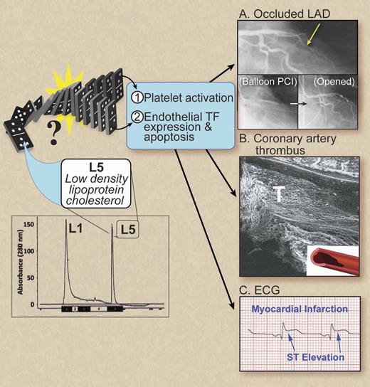 Can bad cholesterol get worse? L5, the most electronegative LDL fraction isolated chromatographically, was found to be significantly elevated in patients with STEMI compared with normal controls.1 Ex vivo, L5 not only enhanced adenosine 5′-diphosphate-stimulated platelet aggregation, platelet P-selectin expression, and GP IIb/IIIa activation but also induced both endothelial tissue factor and P-selectin expression and apoptosis. Together, these data provide mechanistic details of the thrombophilic state created by L5 that could cause a domino effect and produce an occlusive coronary artery thrombosis resulting in an STEMI. (A) Coronary angiogram showing an occluded left anterior descending coronary artery (LAD) during STEMI and inserts showing balloon percutaneous coronary intervention (PCI) and the angiogram after opening the LAD. (B) Scanning electron micrograph of bisected LAD from a pig with an occlusive thrombosis (T) causing an STEMI. (C) Electrocardiogram showing a STEMI. Professional illustration by Debra T. Dartez.