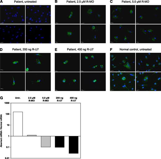 Figure 4. Ex vivo splicing correction in patient’s megakaryocytes. Hematopoietic progenitor cells were isolated from peripheral blood and differentiated toward the megakaryocytic lineage as described in “Methods.” At day 9 of culture, the FV-deficient patient’s cells were either left untreated (A) or treated with rescuer MO or with the U7-SmOPT construct expressing rescuer U7snRNA at the indicated concentrations (B-E). Untreated cells from a normal control are shown for comparison (F). After immunofluorescence staining with Hoechst 33258 (cell nuclei, in blue) and with a FITC-labeled anti-mouse antibody recognizing the primary anti-FV antibody (FV, in green), cells were examined under a Leica DMI6000CS fluorescence microscope using a 63×/1.40 oil-immersion objective at room temperature. Images were acquired using a DFC365FX camera and analyzed with Leica LAS-AF 3.1.0 software. Each panel represents the overlay of 2 images of the same preparation stained with Hoechst 33258 and FITC-labeled antibody, respectively. Four representative microscope fields are shown for each condition. Following isolation and reverse transcription of total RNA, the F5 mRNA splicing pattern in untreated and treated patient’s megakaryocytes was analyzed by real-time qPCR (G). Results are expressed as the ratio between the aberrant and normal F5 mRNA, plotted on a logarithmic scale. Untr., untreated; R-MO, rescuer MO; R-U7, rescuer U7snRNA.