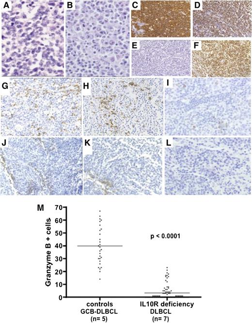 Figure 2. Histochemical characteristics of lymphomas. (A-B) Hematoxylin-eosin staining (original magnification, ×400) of P3-L1 (intra-abdominal lymph node biopsy) and P4-L2 (inguinal lymph node biopsy), showing diffuse, massive infiltration by monomorphic large lymphoid cells. (C-F) Immunohistochemical studies on P3-L1 biopsy showing (C) CD20 staining, (D) Ki67 staining, (E) FISH for EBV-encoded RNA, and (F) BCL6 staining. (G-L) CD3, CD8, and granzyme B immunohistochemical studies: in control GCB DLBCL biopsy, (G) CD3 and (H) CD8 T cells were detected at perivascular and intratumor sites. (I) Granzyme B was detected in many T cells. In the IL-10R–deficient DLBCL (P4-L3) biopsy, (J-K) CD3/CD8 T cells were found in the perivascular region, whereas (L) no granzyme B was detected within the tumor (×200 magnification). (M) Counts of granzyme-B-positive cells in 5 control GCB DLBCLs and 7 lymphomas from IL-10R–deficient patients are shown. Counts per optic field (×400 magnification). Horizontal bars represent mean values.