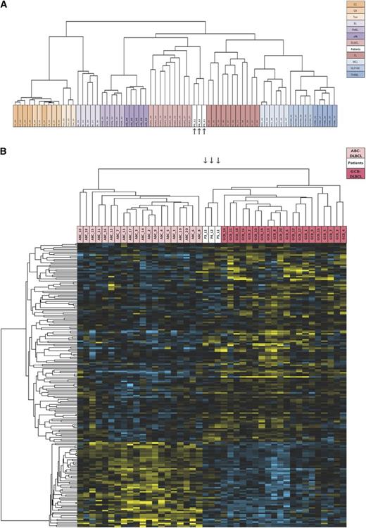 Figure 3. Gene expression profiles. (A) Unsupervised, hierarchical clustering of IL-10R lymphoma samples and other lymphoma samples. The dendrogram is based on expression of the most variable genes. Genes whose median expression was above background and whose standard deviation across all samples was >2 in at least 1 lymphoma entity were used for unsupervised hierarchical clustering (n = 3364). Samples from P3-L1, P4-L2, and P5L1 are shown in white and are indicated by arrows. (B) Hierarchical clustering of IL-10R lymphoma samples and activated B-cell–like (ABC) (light pink) and GCB (dark pink) DLBCL samples. Samples from P3-L1, P4-L2, and P5L1 are shown in white and are indicated by arrows. A list of 227 genes used to discriminate between ABC and GCB DLBCL was extracted via a nonparametric test implemented in the LIMMA software package (P < .05). Gene lists were submitted to the Cluster program for calculation of the Pearson correlation coefficient (as a similarity metric) and centroid linkage clustering. The results were visualized with TreeView software. BL, Burkitt’s lymphoma; CB, centroblasts; CC, centrocytes; cHL, classic Hodgkin’s lymphoma; FL, follicular lymphoma; MCL, mantle cell lymphoma; NPLHL, nodular predominance lymphocytic Hodgkin lymphoma; PMBL, primary mediastinal B-cell lymphoma; THRBL, T-cell/histiocyte-rich large B-cell lymphoma; Ton, tonsils.