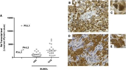 Figure 5. Expression of c-REL messenger RNA and protein. (A) c-REL transcript levels in tumor cells from P3-L1, P4-L2, and P5L1 in comparison with ABC DLBCL and GCB DLBCL controls. The horizontal bar represents the mean value. (B-E) Immunohistochemical staining of c-REL on tumor biopsies (B,D: original magnification, ×400; C,E: detail from B and D, respectively). (B-C) A P4-L4 sample showing nuclear expression of c-REL in tumor cells and the absence of staining in endothelial cells. (D-E) A P4-L1 sample showing c-REL expression in both the nucleus and cytoplasm of tumor cells.