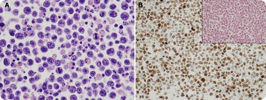 The patient is an 88-year-old Russian man, otherwise healthy, with intermittent “burning” chest pain for the past month that was mainly sternal and radiated to the back. He had progressive shortness of breath limiting his mobility. Computed tomography detected a large pericardial effusion and two 1-cm right and left lung nodules. The effusion was drained and cytology showed large atypical cells with irregular nuclear contours, vesicular chromatin, and multiple prominent nucleoli (panel A). There were numerous apoptotic bodies seen. Immunostains showed the cells to be negative for B-cell and T-cell markers (CD20, PAX5, and CD3) but positive for CD138, CD30, CD45, and Kaposi sarcoma–associated herpes virus/human herpes virus-8 (HHV-8) (panel B). The cells were negative for Epstein-Barr virus (EBV), both by in situ hybridization for encoded RNA (panel B inset) and polymerase chain reaction analysis. Serologic studies for HIV were negative. A diagnosis of primary effusion lymphoma (PEL), EBV negative, was rendered. / The vast majority of PELs (90%-95%) have been associated with HIV and are positive for EBV. This case of PEL is notable in that the patient is HIV negative, elderly, and has a tumor that is negative for EBV. The majority of EBV-negative PELs have been identified in elderly patients, most often originating in the Mediterranean region.