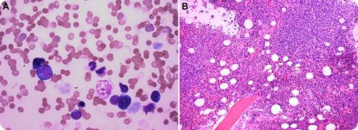 A 43-year-old man presented with fever, fatigue, and shortness of breath. Physical examination revealed bilateral axillary lymphadenopathy. Complete blood count showed hemoglobin of 9.8 g/dL, a white cell count of 4.4 × 109/L, and a platelet count of 195 × 109/L. Blood smear showed increased red blood cell agglutination, polychromasia with nucleated red cells, and atypical lymphocytosis (panel A). Hemolysis was evident, with raised serum bilirubin (2.3 mg/dL), low serum haptoglobin (4 mg/dL), high serum lactate dehydrogenase, direct Coombs test positive, and cold agglutinins (1:256). Serology studies for hepatitis B or hepatitis C were negative. Laboratory work-up detected hypergammaglobulinemia (3.9 g/dL) with increased serum immunoglobulin G (IgG) (2408 mg/dL), IgM (599 mg/dL), and IgE (175 mg/dL) with an IgG κ monoclonal paraprotein. A bone marrow biopsy revealed dense nodular atypical lymphoid infiltrates, plasmacytosis, and megakaryocytic hyperplasia (panel B). Biopsy of the axillary lymph nodes showed diffuse large B-cell lymphoma. Subsequently, the patient was discovered to be positive for HIV type 1, with a viral load of 485 315 copies per microliter, and a CD4 cell count of 215 per microliter. / All patients with unexplained cold agglutination and hypergammaglobulinemia associated with lymphoma should undergo screening for HIV infection; peripheral blood analysis may be useful in the diagnosis of marrow involvement by lymphoma.
