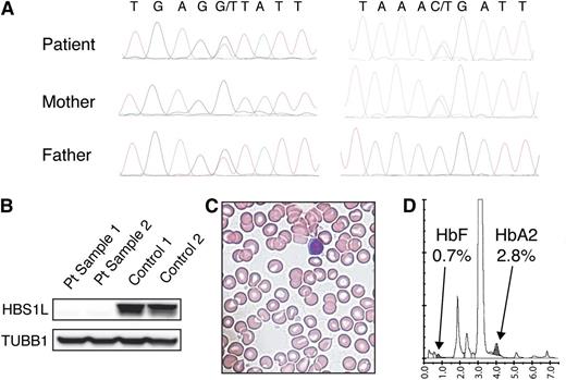 Figure 1. Complete loss of function of HBS1L results in a unique phenotype without hematologic abnormalities. (A) Sanger sequencing confirms the presence of compound heterozygosity for 2 loss-of-function mutations in HBS1L inherited from the father and mother, respectively. (B) Western blotting demonstrates the absence of HBS1L protein in 2 samples of fibroblasts from the proband, whereas it is present in 2 control samples. A tubulin β (TUBB1) loading control is present in similar amounts in all 4 samples. (C) A representative image of a blood smear shown at 100× shows normal red cell morphology without any other notable abnormalities, consistent with what is seen from examination of hundreds of similar fields. (D) Hemoglobin high-performance liquid chromatography analysis shows a normal distribution of hemoglobin subtypes in the patient.