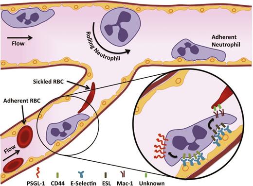 Figure 1. Sickle cell VOC. SS-RBCs and other inflammatory mediators induce the activation of the endothelium. The damaged and stimulated endothelium is poised to recruit leukocytes. E-selectin on the endothelium is crucial for generating a secondary wave of activating signals, which produces a polarized expression of activated αMβ2 integrin (Mac-1) at the leading edge of the crawling neutrophil, allowing the capture of circulating discoid and sickle-shaped erythrocytes. These events culminate in VOC in the postcapillary venules.