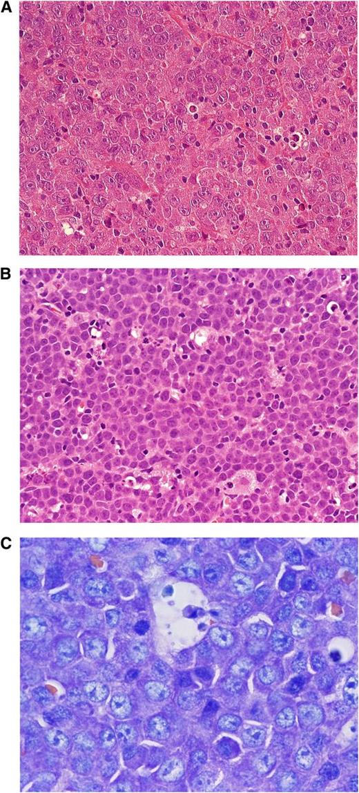 Figure 3. Aggressive lymphomas with MYC translocations. (A) MYC-rearranged DLBCL. Note large blastic cells with broad cytoplasm and large nuclei, finely dispersed nuclear chromatin, and single prominent nucleoli (H&E stain; magnification, 400×). (B) BCLU. In comparison with BL, the tumor cells are slightly larger and harbor more irregular nuclei, sometimes with single nucleoli. Some histiocytes are interspersed, but there is no clearcut starry sky pattern (H&E stain; magnification, 400×). (C) PBL MYC rearranged. The cells are small to intermediate in size. Giemsa stain highlights the plasmablastic features of the tumor cells. CD20 was negative in this tumor (magnification, 1000×).