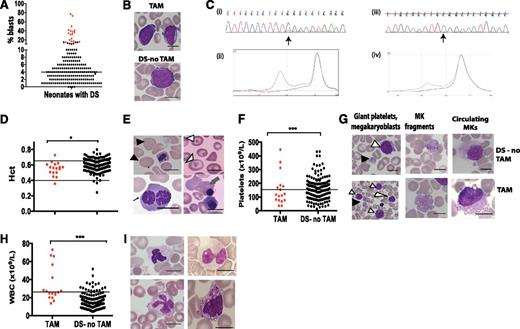 Figure 1. Hematologic abnormalities and GATA1 mutation analysis by Ss/DHPLC in neonates with DS. (A) Percentage of blasts on blood films from the first week of life in 200 neonates with DS, 17 with TAM (red circles) and 183 without TAM (black circles). (B) Photomicrographs of typical blast cells in a neonate with TAM (top) and in a DS neonate without TAM (bottom). (C) GATA1 mutation analysis in TAM by Ss and DHPLC. (Ci,ii) Mutation analysis of sample DST11. The mutation is detected by both Ss and DHPLC. (Ci) Sanger sequence trace. The arrow points the start of a double sequence trace indicative of an acquired GATA1 mutation. (Cii) DHPLC trace from the same sample (red line, mutant; black line, normal). (Ciii,iv) Mutation analysis of sample DST9. The mutation is detected by DHPLC but not by Ss. (Ciii) Sequence trace. (Civ) DHPLC trace from the same sample (red line, mutant; black line, normal). (D,F,H) Scatter graphs of hematocrit (D), platelet counts (F), and leukocytes (H) in 200 DS neonates in the first week of life, 17 with TAM (red circles) and 183 without TAM (black circles). The horizontal lines show the upper and/or lower limits of the normal neonatal laboratory range (see supplemental Methods). (E,G,I) Photomicrographs of erythrocyte (E), platelet (G), and leukocyte (I) morphologic abnormalities in neonates with DS. (E) Top left: macrocytes (black arrowheads); top right: target cells (white arrowheads); bottom left: dyserythropoietic erythroblasts (fine black arrow); bottom right: basophilic stippling (gray arrow). (G) Examples of giant platelets (GP) (black arrowhead) and megakaryoblasts (white arrowhead), megakaryocyte fragments (MK fragment), and circulating megakaryocytes (MKs) in blood films from DS neonates without TAM (top row) and with TAM (bottom row). (I) Top left: hypogranular neutrophil; top right: pseudo-Pelger neutrophil; bottom left: monocyte with stellate nucleus; bottom right, dysplastic basophil. Scale bars indicate 10 μm. WBC, white blood cell.