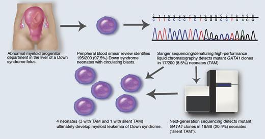 (1) Abnormal fetal myeloid progenitor department, where GATA1 mutant clones arise in the fetal liver; (2) 200 Down syndrome neonates are screened; (3) 195/200 (97.5%) have circulating blasts; (4) Sanger sequencing/denaturing high-performance liquid chromatography detects mutant GATA1 clones in 17/200 (8.5%) patients (TAM); (5) next-generation sequencing detects mutant GATA1 clones in 18/88 (20.4%) patients (“silent TAM”); (6) myeloid leukemia of Down syndrome develops in 3 TAM patients and 1 silent TAM patient. Professional illustration by Marie Dauenheimer.