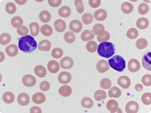 A 2-month-old girl, who was current on her immunizations and had no prior illness, presented to the emergency department with a 2-week history of progressive cough and shortness of breath. A chest radiograph revealed bilateral peribronchial thickening. Complete blood count results revealed a white blood cell count of 38.6 × 109/L (71% lymphocytes, 19% segmented neutrophils, 6% monocytes, 3% bands, and 1% metamyelocytes); hemoglobin level was 10.7 g/dL, and platelet level was 425 × 109/L. Morphologic examination of the peripheral blood smear revealed numerous mature lymphocytes with scant cytoplasm, condensed chromatin, and clefted nuclei—characteristic of Bordetella pertussis lymphocytosis. Real-time polymerase chain reaction was positive for B pertussis and negative for respiratory syncytial virus and influenza A and B. The patient was treated with azithromycin and prednisolone. / Pertussis has a wide spectrum of presentation, and a high index of suspicion must be maintained. Analyzing culture is the gold standard for diagnosis; however, polymerase chain reaction is a rapid and more sensitive test. Studies of pertussis in children show absolute lymphocytosis in >50% of patients, and characteristic small, mature lymphocytes with hyperchromatic, cleaved nuclei may account for as much as 56% (12%-56%; mean, 31%) of total lymphocytes. This case emphasizes the importance of peripheral blood smear evaluation as a diagnostic tool until other results become available.