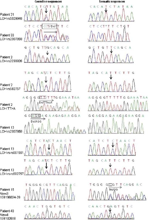 Figure 2. Sanger sequencing identification of TNFAIP3 somatic mutations or deletions in pSS patients with lymphoma. Sanger sequencing results for each TNFAIP3-mutated somatic sample are shown. Arrows indicate site of nucleotide change. Traces shown are representative of at least 2 independent amplification and sequencing reactions.
