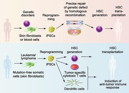 Figure 1. Therapeutic potential of hPSCs for blood diseases. iPSCs can be potentially used to treat patients with monogenic genetic blood diseases such as sickle cell anemia, β-thalassemia, Fanconi anemia, or SCID (upper panel). Autologous skin or blood cells from these patients can be reprogrammed into iPSCs. The defective gene in iPSCs can be repaired using homologous recombination. De novo generation of HSCs from gene-corrected iPSCs would provide immunologically matched cells for bone marrow transplantation. For cancer therapy, autologous iPSCs could be generated from skin fibroblasts or other somatic cells lacking leukemia mutation and used to generate HSCs for bone marrow transplantation as well as immune cells to induce an anti-leukemia immune response (lower panel). Professional illustration by Paulette Dennis.