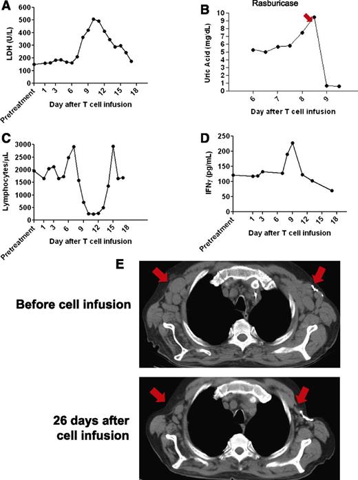 Figure 2. Tumor lysis syndrome and regression of adenopathy occurred after infusion of allogeneic anti-CD19-CAR T cells into patient 1. (A) Serum lactate dehydrogenase (LDH) levels increased after the CAR-transduced T-cell infusion and then decreased as toxicity resolved. (B) The serum uric acid was 5.4 mg/dL (normal range 3.7-8.6 mg/dL) before the CAR T-cell infusion. Eight days after the infusion, the serum uric acid increased sharply before the recombinant urate oxidase drug rasburicase was given to reduce the uric acid. (C) Shortly after infusion of anti-CD19-CAR T cells, the total blood lymphocyte count abruptly decreased and then recovered to normal levels. (D) Serum IFN-γ levels at the indicated days after anti-CD19-CAR T-cell infusion were determined by enzyme-linked immunosorbent assay. A transient increase in serum IFN-γ occurred during the period of clinical toxicity. (E) CT scans were performed before the anti-CD19-CAR T-cell infusion and 26 days after the anti-CD19-CAR T-cell infusion. A decrease in adenopathy occurred at the locations indicated by the arrows.