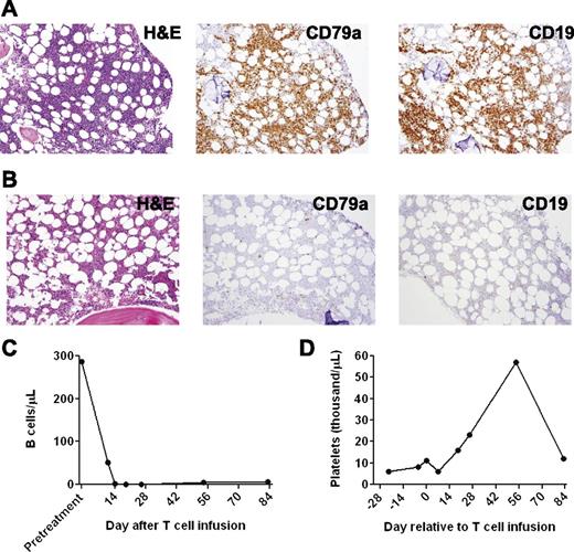 Figure 3. A profound eradication of CLL cells from the bone marrow and blood occurred after infusion of anti-CD19-CAR T cells into patient 1. (A) A bone marrow biopsy was performed 2 days before anti-CD19-CAR T cells were infused. Bone marrow immunohistochemistry staining showed that 80% to 90% of the bone marrow cells consisted of atypical lymphoid cells that had a morphology consistent with CLL. The atypical lymphoid cells were CD79a+ and CD19+. Flow cytometry staining for immunoglobulin light chain restriction showed that the cells were clonal (not shown). (B) Twenty-six days after the anti-CD19-CAR T-cell infusion, immunohistochemistry staining of a bone marrow specimen showed no morphologic evidence of CLL. Only rare CD79a+ cells were present. (C) Blood B cells, of which 99% were CLL cells, dropped dramatically after infusion of anti-CD19-CAR T cells. (D) Patient 1 was dependent on platelet transfusions before the infusion of anti-CD19-CAR T cells. After the CAR T-cell infusion, the patient no longer required platelet transfusions. His platelet count increased for ∼2 months after the anti-CD19-CAR T-cell infusion; subsequently, his platelet count decreased when his CLL progressed.