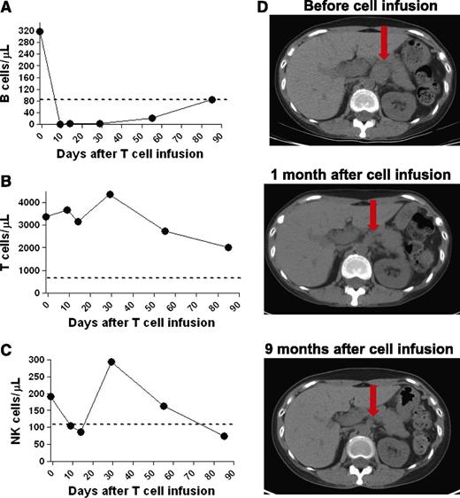 Figure 4. Patient 5 obtained a CR after infusion of anti-CD19-CAR T cells. (A) Within 9 days after infusion of anti-CD19-CAR T cells, B cells were eradicated from the blood of patient 5. T cells (B) and NK cells (C) were at normal levels in the blood of patient 5 at the time of anti-CD19-CAR T-cell infusion. T-cell levels remained in the normal range, whereas NK cell levels fluctuated. The dashed line on the plots in panels A-C is the lower limit of the normal range of each cell type. (D) CT scans show that abdominal adenopathy regressed in patient 5 after infusion of anti-CD19-CAR T cells. The red arrows indicate a lymph node mass that regressed to a normal-sized lymph node.